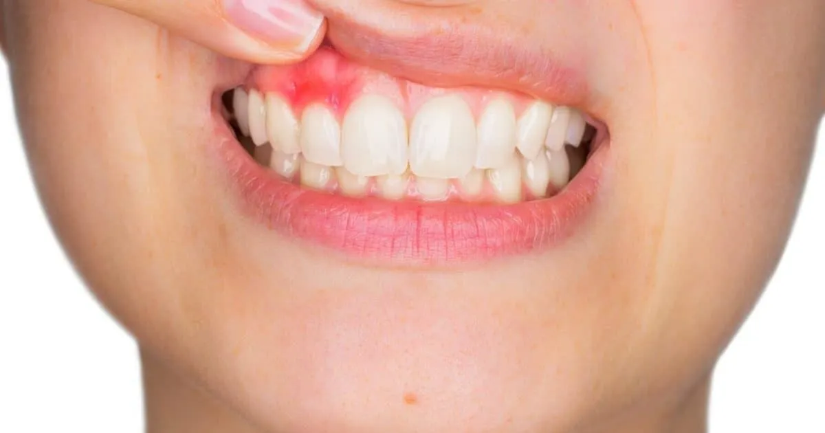 Dental Abscess Management